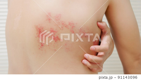 man with shingles disease 91143096