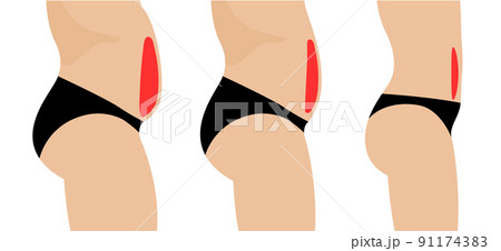 Liposuction fat plastic surgery fat change belly body cellulite shape. Cosmetic surgery vector woman 91174383