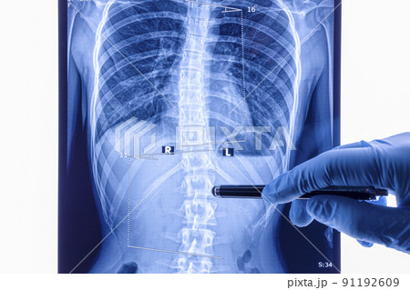 Doctor analyzing X ray of the spine showing scoliosis in the lumbar area Doctor analyzing X ray of the spine showing scoliosis in the lumbar area 91192609