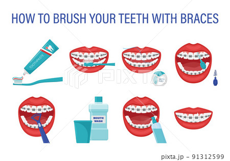 Infographic how to brush your teeth with braces. Step-by-step instructions. Oral hygiene. Healthy lifestyle and dental care. Clean white teeth. Prevention of caries. Isolated flat vector illustration. Infographic how to brush your teeth with braces. Step-by-step instructions. Oral hygiene. Healthy lifestyle and dental care. Clean white teeth. Prevention of caries. Isolated flat vector illustration. 91312599