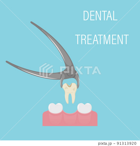 Dental tooth extraction. Exodontia. The tooth in the dental forceps. A white clean tooth is clamped between the forceps. Professional dental instrument. Isolated flat vector illustration. Dental tooth extraction. Exodontia. The tooth in the dental forceps. A white clean tooth is clamped between the forceps. Professional dental instrument. Isolated flat vector illustration. 91313920