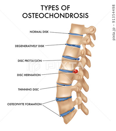 Spine Hernia Realistic Chart Spine Hernia Realistic Chart 91354498