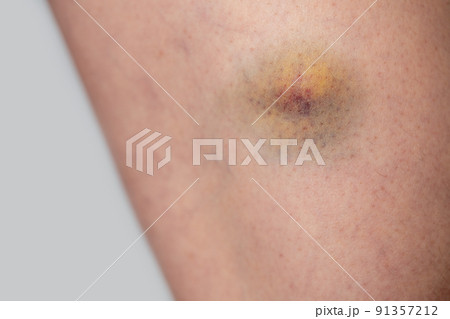 太ももにできた痣 91357212