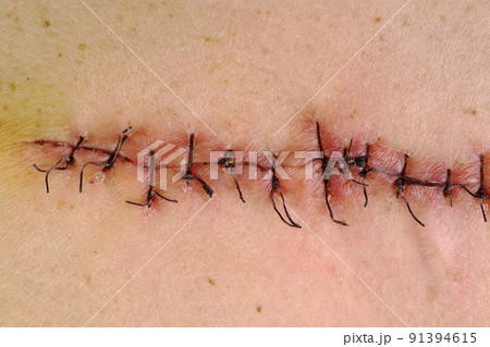 Medical sutures, stitches after surgery, stitched surgical sutures on human body. Medical surgical care. 91394615