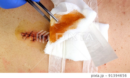 Medical sutures, stitch after surgery, stitched surgical sutures on human body smeared betadine. 91394656