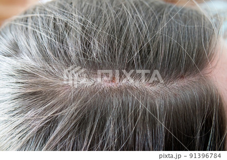 Seborrheic dermatitis - long-term serious skin disorder, dermatology medicine problem. 91396784