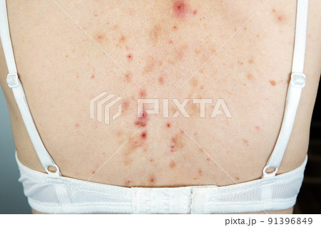 Acne sequelae, torn pimples, skin itching on the back, dermatological problem. Acne sequelae, torn pimples, skin itching on the back, dermatological problem. 91396849