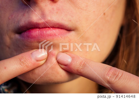 post-acne, scars and red festering pimples on the face of a young woman. concept of skin problems post-acne, scars and red festering pimples on the face of a young woman. concept of skin problems 91414648