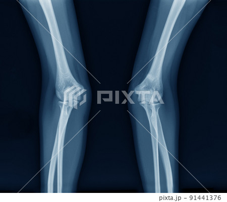 elbow joint x ray image elbow joint x ray image 91441376