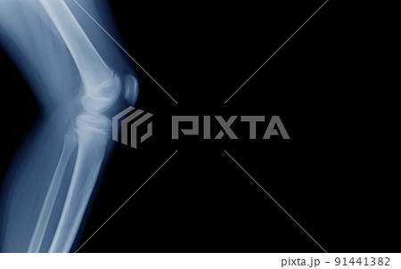lateral view of knee joint 91441382