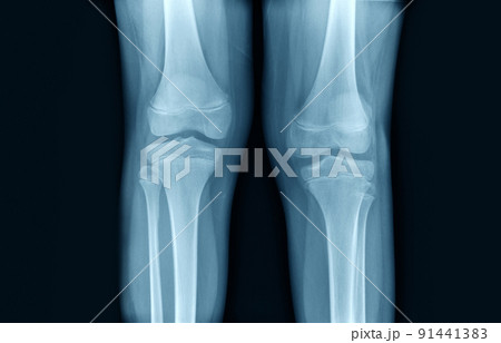 knee joint x ray in blue tone 91441383