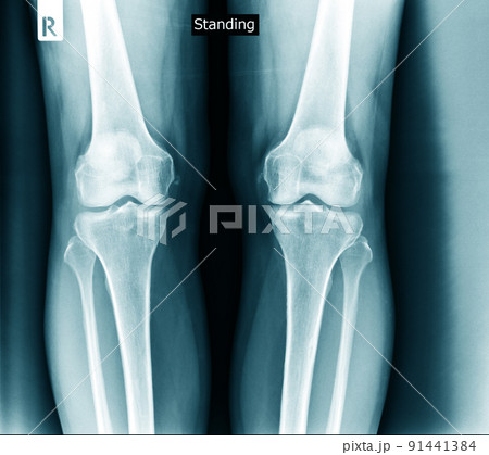 knee joint x ray degeneration knee joint x ray degeneration 91441384