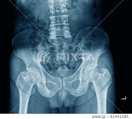 human pelvic bone x ray 91441385