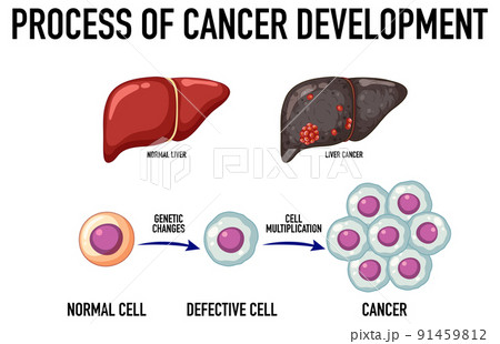 Diagram showing cancer development process Diagram showing cancer development process 91459812