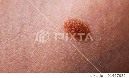 Closeup brown mole on caucasian woman skin. 91467022