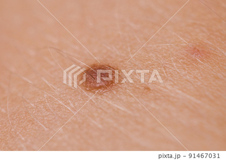 Closeup brown mole on caucasian woman skin. Closeup brown mole on caucasian woman skin. 91467031