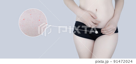 Irritation of the skin of the bikini area. consequences of depilation. Skin injuries. Pimples and redness after shaving. Panty area care concept. Sugaring and waxing. Cream against acne and redness 91472024