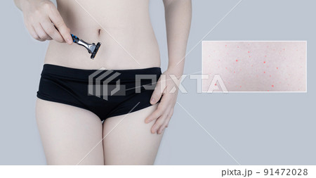 Irritation of the skin of the bikini area. consequences of depilation. Skin injuries. Pimples and redness after shaving. Panty area care concept. Sugaring and waxing. Cream against acne and redness 91472028