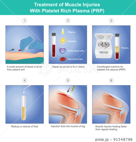 Treatment of Muscle Injuries With Platelet Rich Plasma. Diagram treatment of muscle injuries a knee from blood platelet a patient. Treatment of Muscle Injuries With Platelet Rich Plasma. Diagram treatment of muscle injuries a knee from blood platelet a patient. 91548796