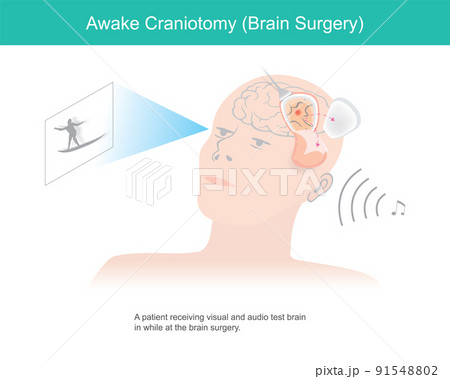 Awake craniotomy. A patient receiving visual and audio test brain in while at brain surgery. Awake craniotomy. A patient receiving visual and audio test brain in while at brain surgery. 91548802