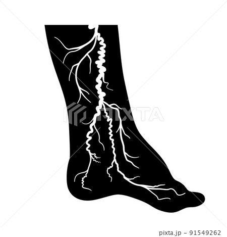Varicose veins treatment 91549262