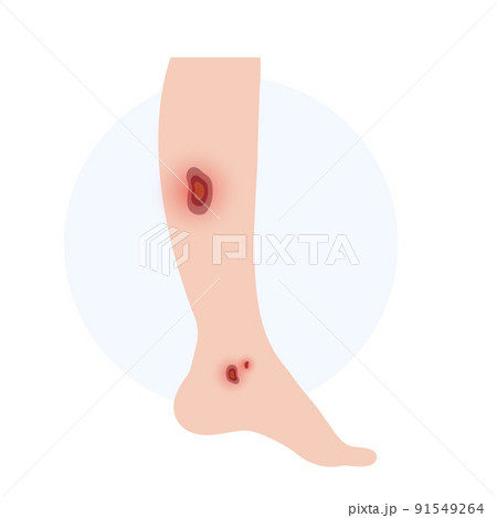 Trophic ulcer anatomy 91549264