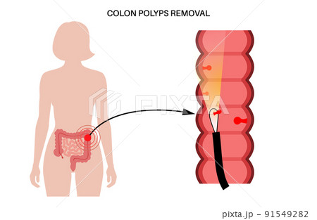 Colon polyps inflammation 91549282