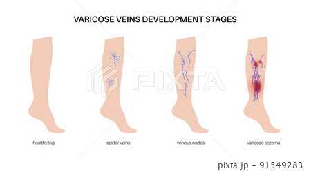 Varicose veins treatment 91549283