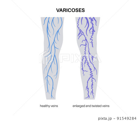 Varicose veins treatment 91549284