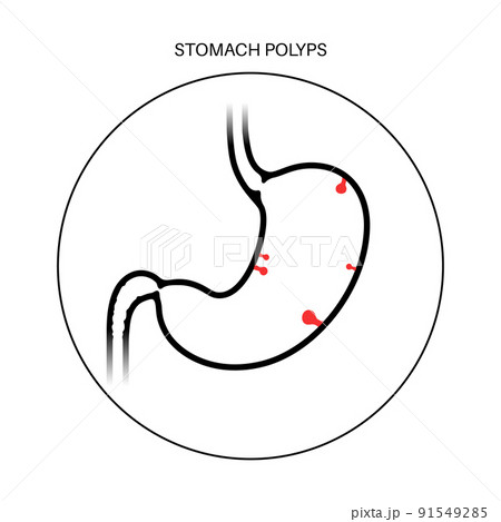 Stomach polyp disease 91549285