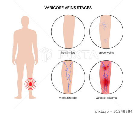 Varicose veins treatment 91549294