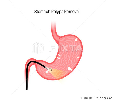 Stomach polyp removal 91549332