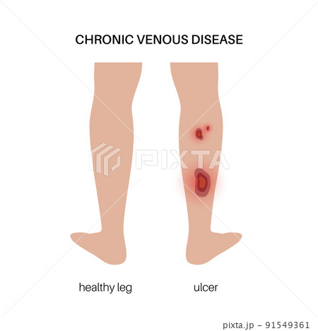 Trophic ulcer anatomy 91549361