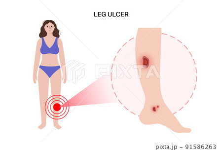 Trophic ulcer anatomy 91586263