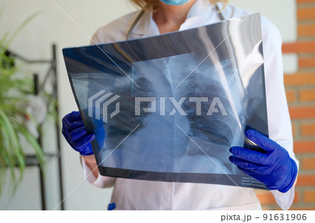 Doctor holding x-ray photograph of lungs in hands 91631906