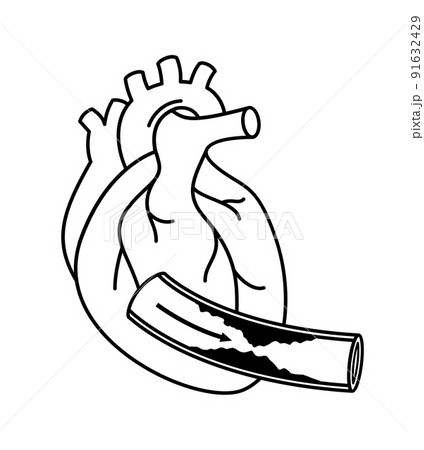 Human heart with Coronary Artery Disease.  91632429