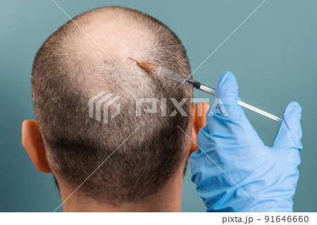 Close up of male head with alopecia during a mesotherapy procedure with a trichologist. Back view. Turquoise background. The concept of baldness and professional treatment 91646660