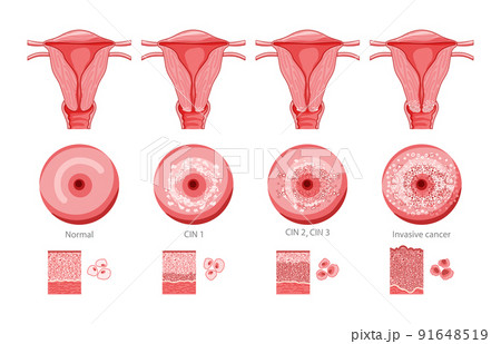 Set of Cervical invasive cancer intraepithelial neoplasia Dysplasia 1 2,3 and normal stage cell morphology on pap smear Set of Cervical invasive cancer intraepithelial neoplasia Dysplasia 1 2,3 and normal stage cell morphology on pap smear 91648519