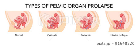 Set of Prolapses types pelvic organ cystocele, uterine, rectocele. Female reproductive system uterus. Human anatomy Set of Prolapses types pelvic organ cystocele, uterine, rectocele. Female reproductive system uterus. Human anatomy 91648520