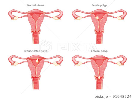Set of Polyps in the uterus Female reproductive system in cross sections diseases and normal. Front view in a cut. Human Set of Polyps in the uterus Female reproductive system in cross sections diseases and normal. Front view in a cut. Human 91648524