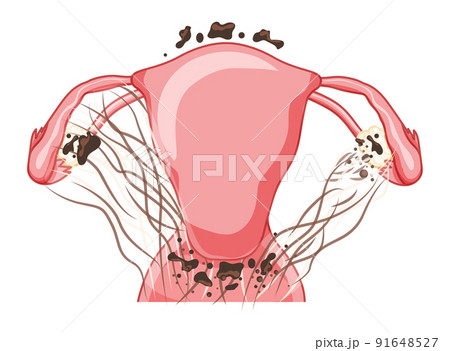 Endometriosis 4 stage Female reproductive system pain pcos tissue cancer cyst uterus. Front view. Human anatomy internal 91648527