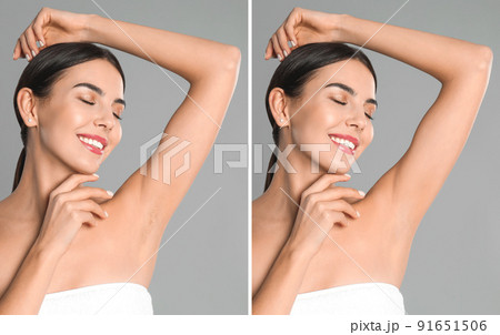 Collage of woman showing armpit before and after epilation on light grey background Collage of woman showing armpit before and after epilation on light grey background 91651506