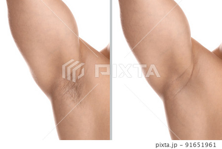 Collage of man showing armpit before and after epilation on white background, closeup Collage of man showing armpit before and after epilation on white background, closeup 91651961