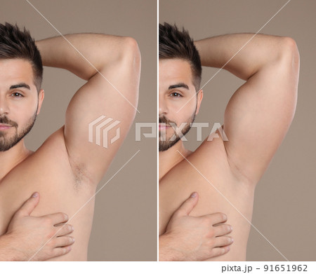 Collage of man showing armpit before and after epilation on light brown background Collage of man showing armpit before and after epilation on light brown background 91651962