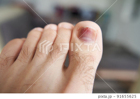 A toe is injured, a heavy object has fallen on the finger. Hematoma under the nail 91655625