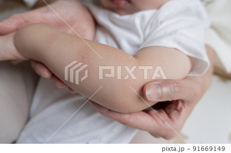 こどもの腕にある虫刺され跡や痣のイメージ 91669149