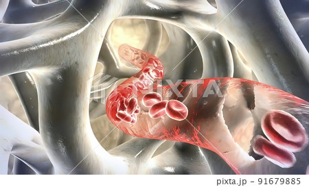 Deficiency of calcium and bone resorption Deficiency of calcium and bone resorption 91679885
