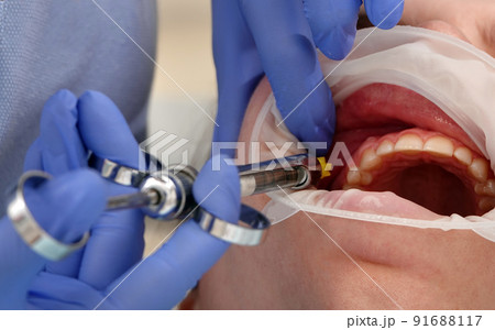 Doctor dentist makes anesthesia to the patient 91688117