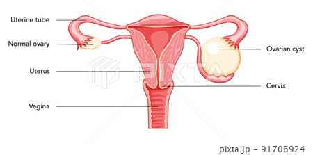 Ovarian cyst Female reproductive system uterus in Anatomical infographic diagram with inscriptions in Latin text. Human 91706924
