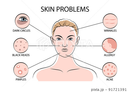 Skin Problems Infographics 91721391